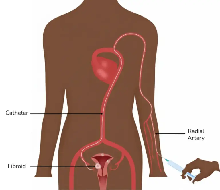 DRS Fibroid Embolization Diagram