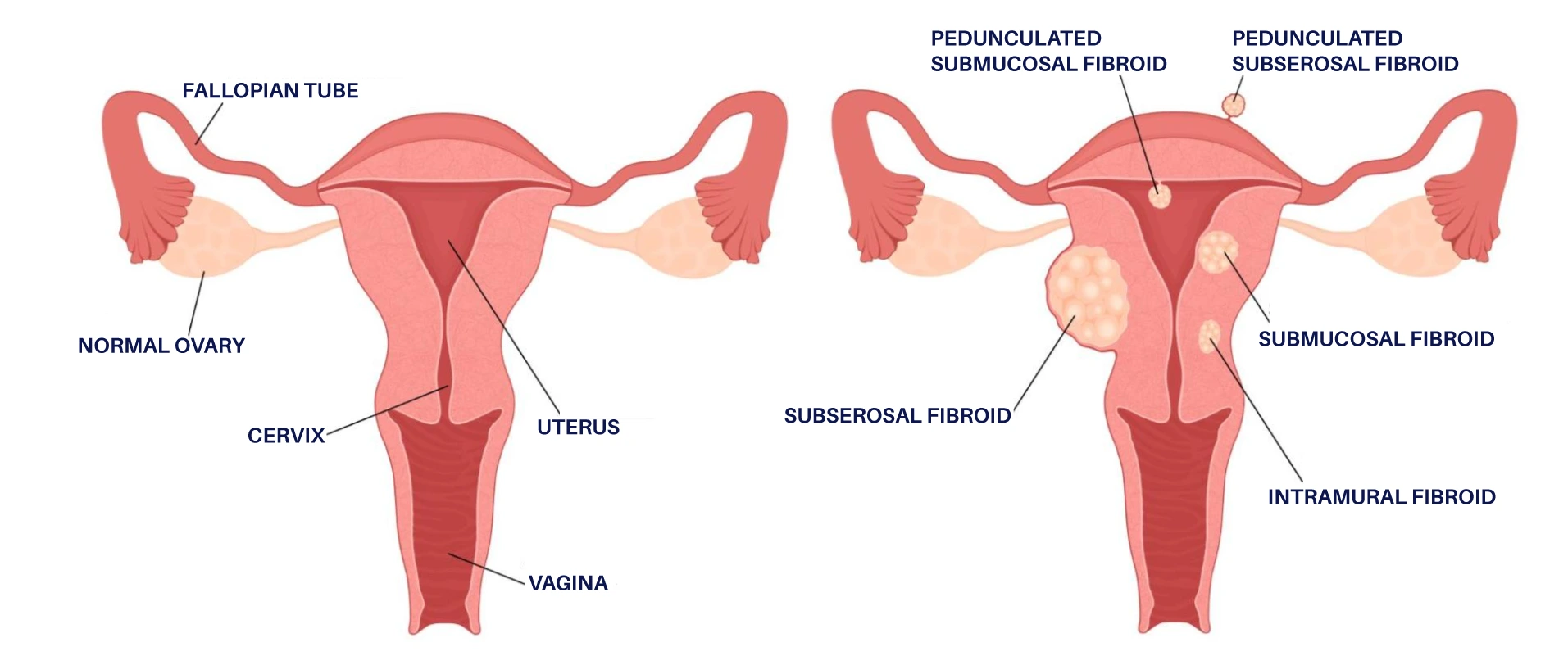 type of fibroids diagram